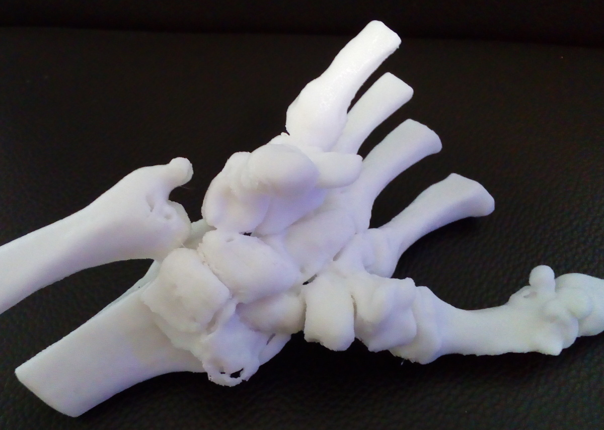 3D-Ausdruck, distale Radiusfraktur