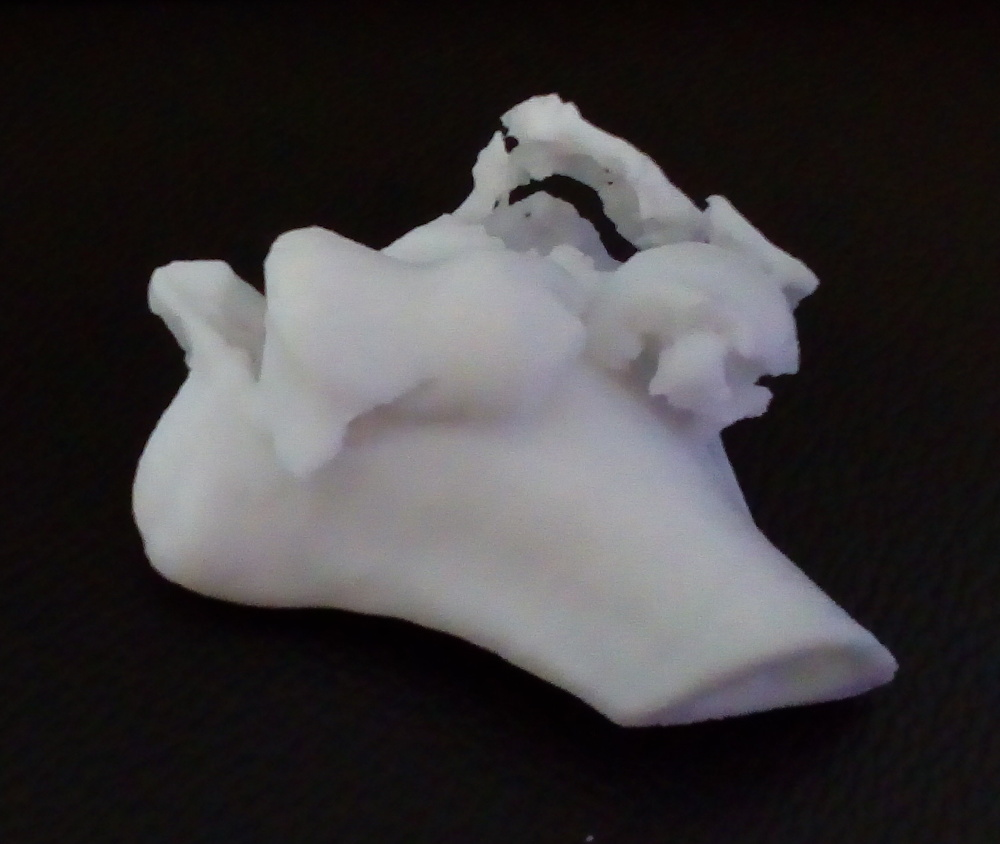 3D-Ausdruck, Suprakondyläre Humerusfraktur